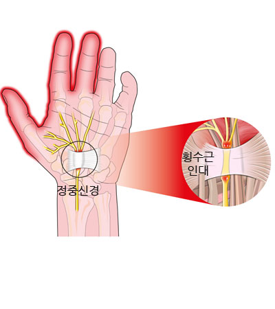 수슨관 증후군